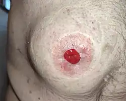 Frontaal aanzicht van een stomabreuk