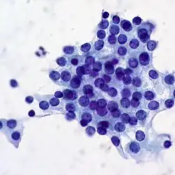 Een bijschildklieradenoom, fijne-naaldbiopsie. Tumorcellen paars, tussenliggend bindweefsel blauw.