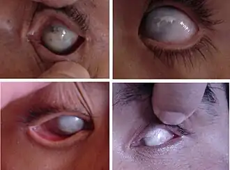 Sclerocornea, afakie en microftalmie