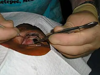 Chirurgische verwijdering van het pterygium.