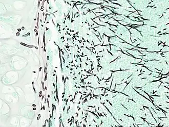 Histopathologische afbeelding van invasieve aspergillose bij een patiënt met interstitiële pneumonia. Autopsiemateriaal. Grocotts methenamine zilverkleuring.