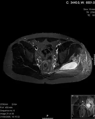 Transversale T2 MRI ter hoogte van de heup laat abcessen zien bij een pyomyositis-patiënt.