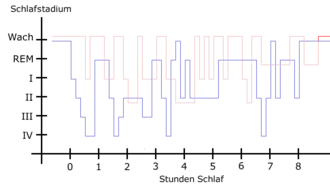 Slaappatroon van een patiënt met rusteloze benen (rood) versus een normaal slaappatroon (blauw).