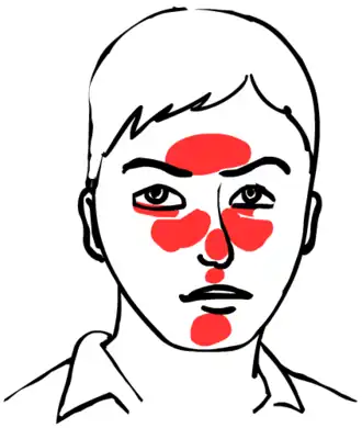 De aangedane regio's van het gelaat bij rosacea
