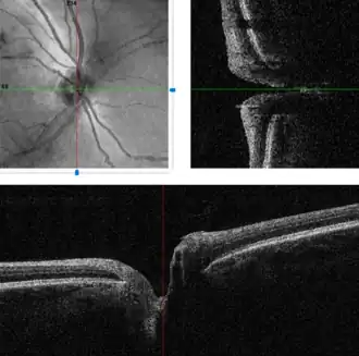 {OCT-scan van het netvlies