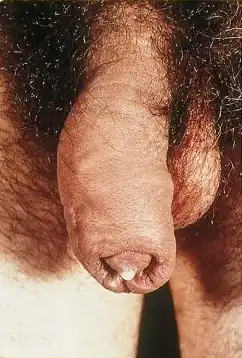 penis met gonorroe