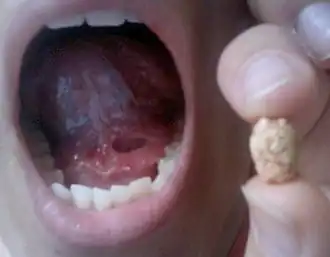 Verwijderde speekselsteen in de onderkaakspeekselklier