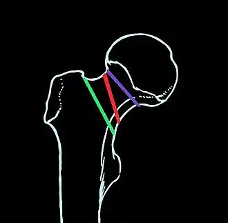 Paars = mediale collumfractuur, rood = mediale transversale collumfractuur, groen = laterale collumfractuur