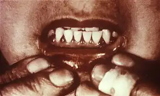 Tandvleesbloedingen ten gevolge van scheurbuik.