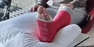 Red synthetic orthopedic leg cast