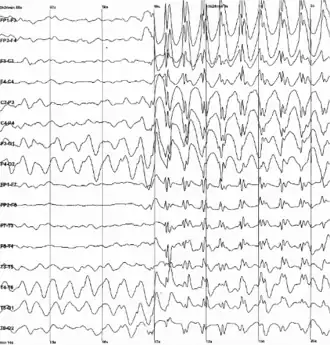 Gegeneraliseerde 3Hz 'spike & wave' ontladingen op het EEG