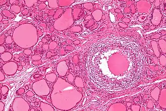 Subacute granulomateuze thyreoïditis