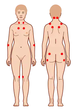 criteria voor fibromyalgie negen gepaarde tenderpoints (1990 American College of Rheumatology criteria for fibromyalgia).