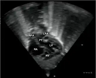 Echocardiogram van transpositie van de grote vaten