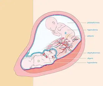 Tweelingtransfusiesyndroom