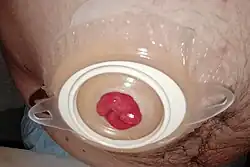 Urostoma en huidplak (tweedelig systeem)