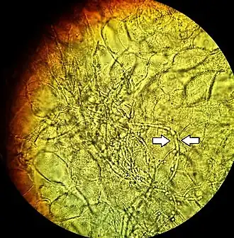 Vaginale candidainfectie