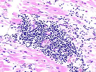 Histopathologische weergave van virale myocarditis tijdens autopsie na acuut hartfalen.