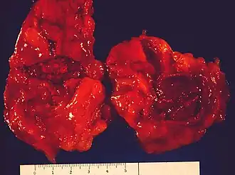 Syndroom van Waterhouse-Friderichsen