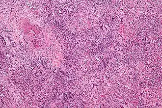 Preparaat met angiitis met granulomen en meerkernige reuscellen