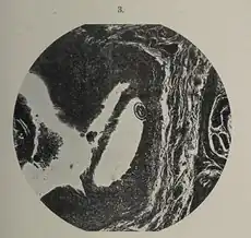 Epitheelwoekeringen en een ei met een L1-larve